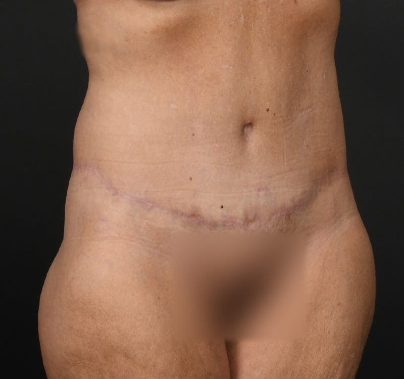 Tummy Tuck Before & After Gallery - Patient 286245 - Image 4