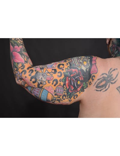 Arm Lift Before & After Gallery - Patient 220855 - Image 1