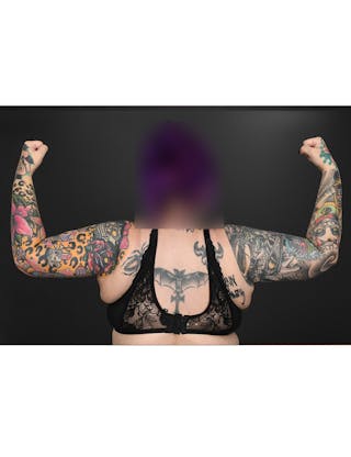Arm Lift Before & After Gallery - Patient 220855 - Image 4