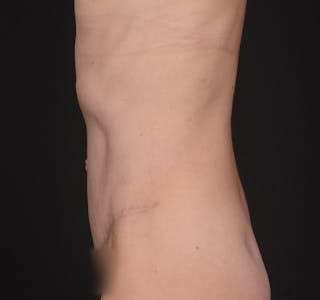Tummy Tuck Before & After Gallery - Patient 324478 - Image 8