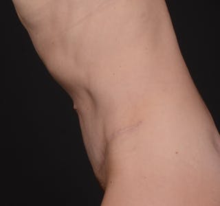 Tummy Tuck Before & After Gallery - Patient 324478 - Image 12