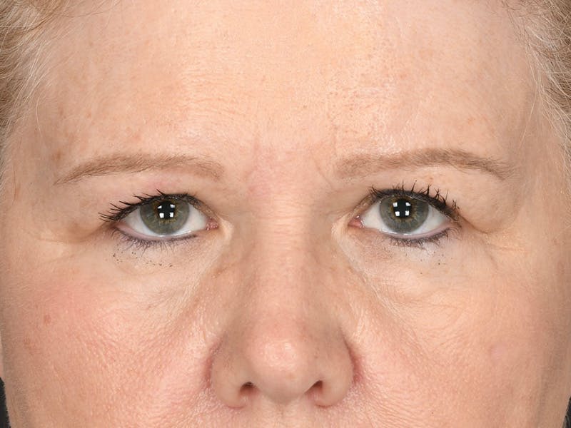 Blepharoplasty Before & After Gallery - Patient 175916 - Image 1