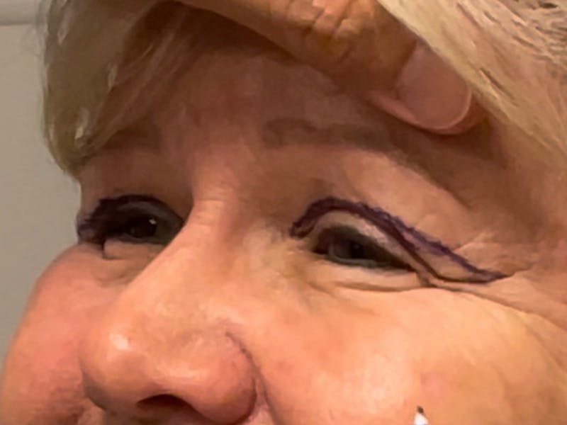 Blepharoplasty Before & After Gallery - Patient 175916 - Image 3