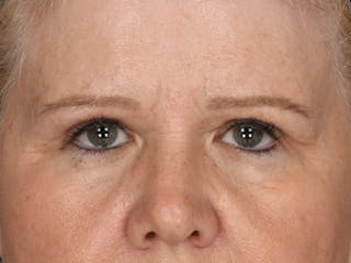 Blepharoplasty Before & After Gallery - Patient 175916 - Image 2