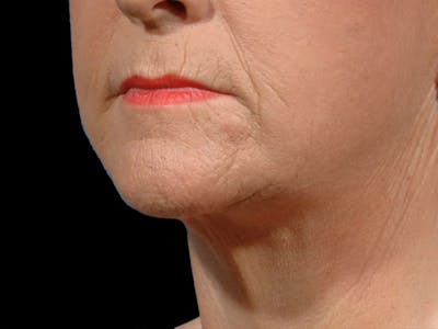 Neck Lift Before & After Gallery - Patient 134189 - Image 2