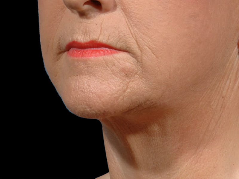 Neck Lift Before & After Gallery - Patient 134189 - Image 2