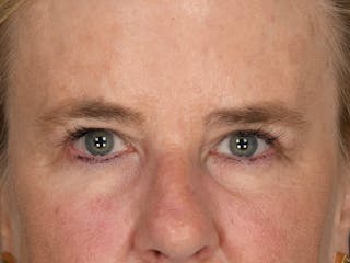 Blepharoplasty Before & After Gallery - Patient 251875 - Image 2