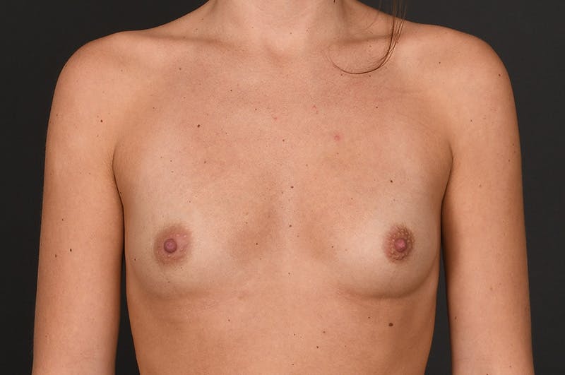 Breast Augmentation Before & After Gallery - Patient 294593 - Image 1