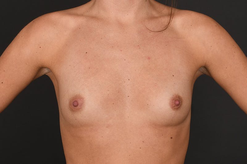 Breast Augmentation Before & After Gallery - Patient 294593 - Image 3