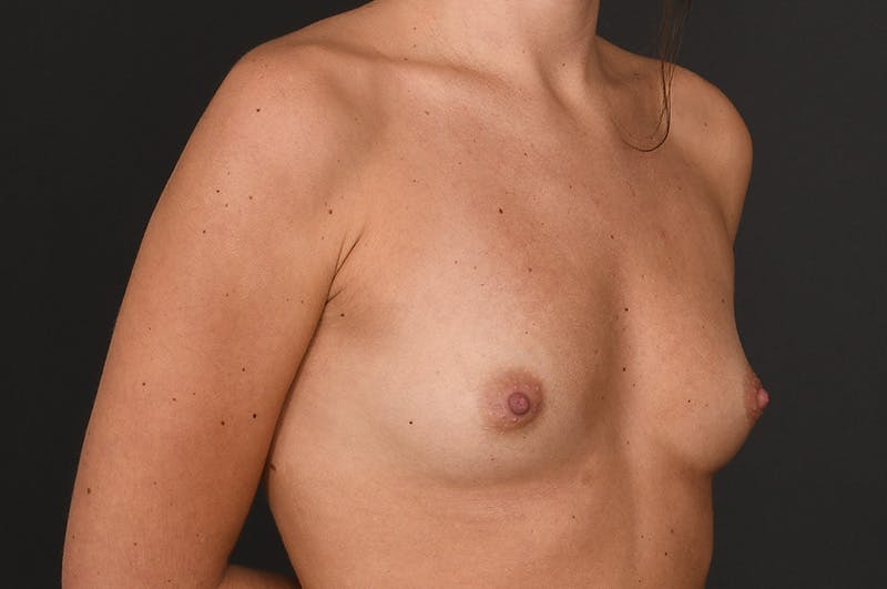 Breast Augmentation Before & After Gallery - Patient 294593 - Image 5