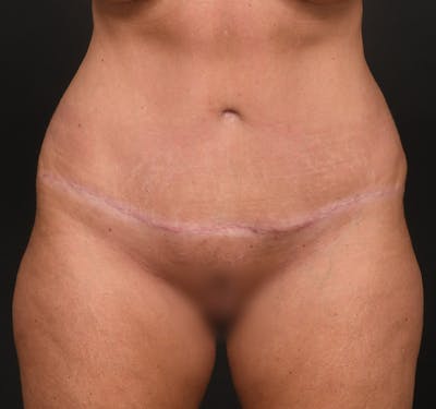 Tummy Tuck Before & After Gallery - Patient 289543 - Image 2