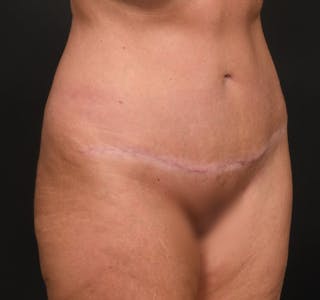 Tummy Tuck Before & After Gallery - Patient 289543 - Image 4