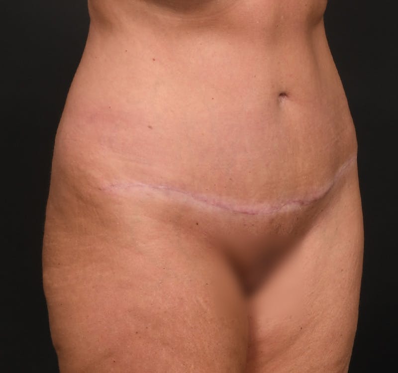 Tummy Tuck Before & After Gallery - Patient 289543 - Image 4