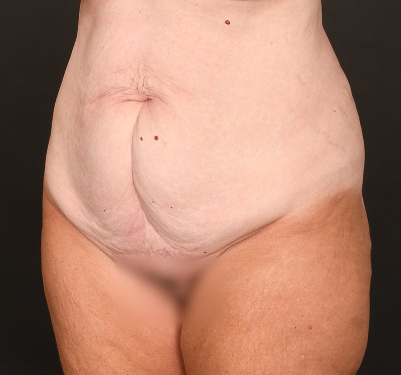 Tummy Tuck Before & After Gallery - Patient 289543 - Image 5