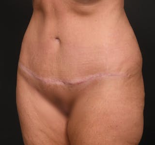 Tummy Tuck Before & After Gallery - Patient 289543 - Image 6