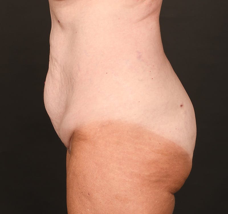 Tummy Tuck Before & After Gallery - Patient 289543 - Image 7