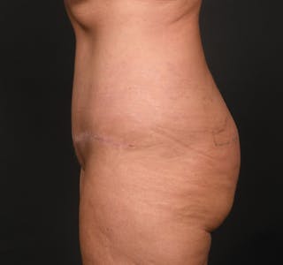 Tummy Tuck Before & After Gallery - Patient 289543 - Image 8