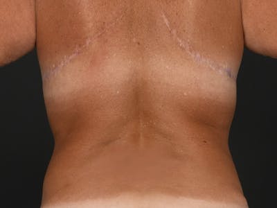 Back Lift Before & After Gallery - Patient 130543 - Image 2