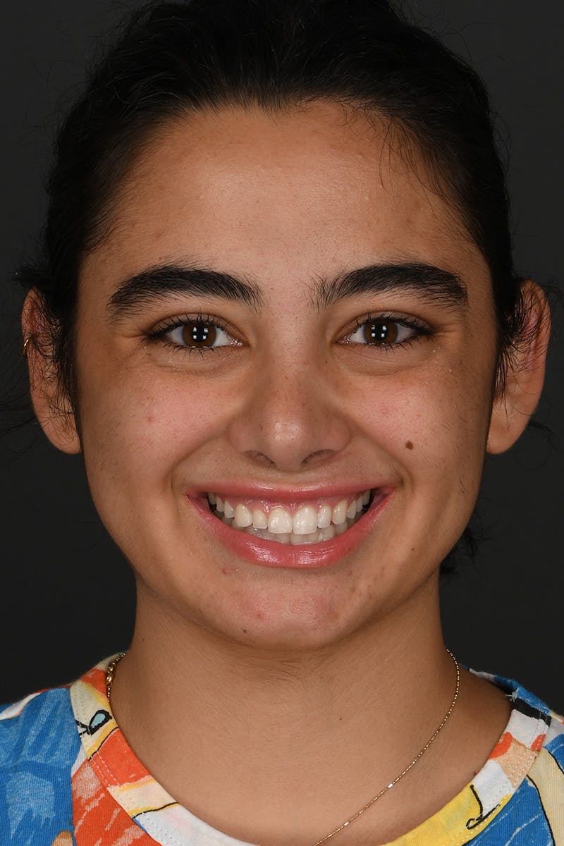 Rhinoplasty Before & After Gallery - Patient 393416 - Image 4