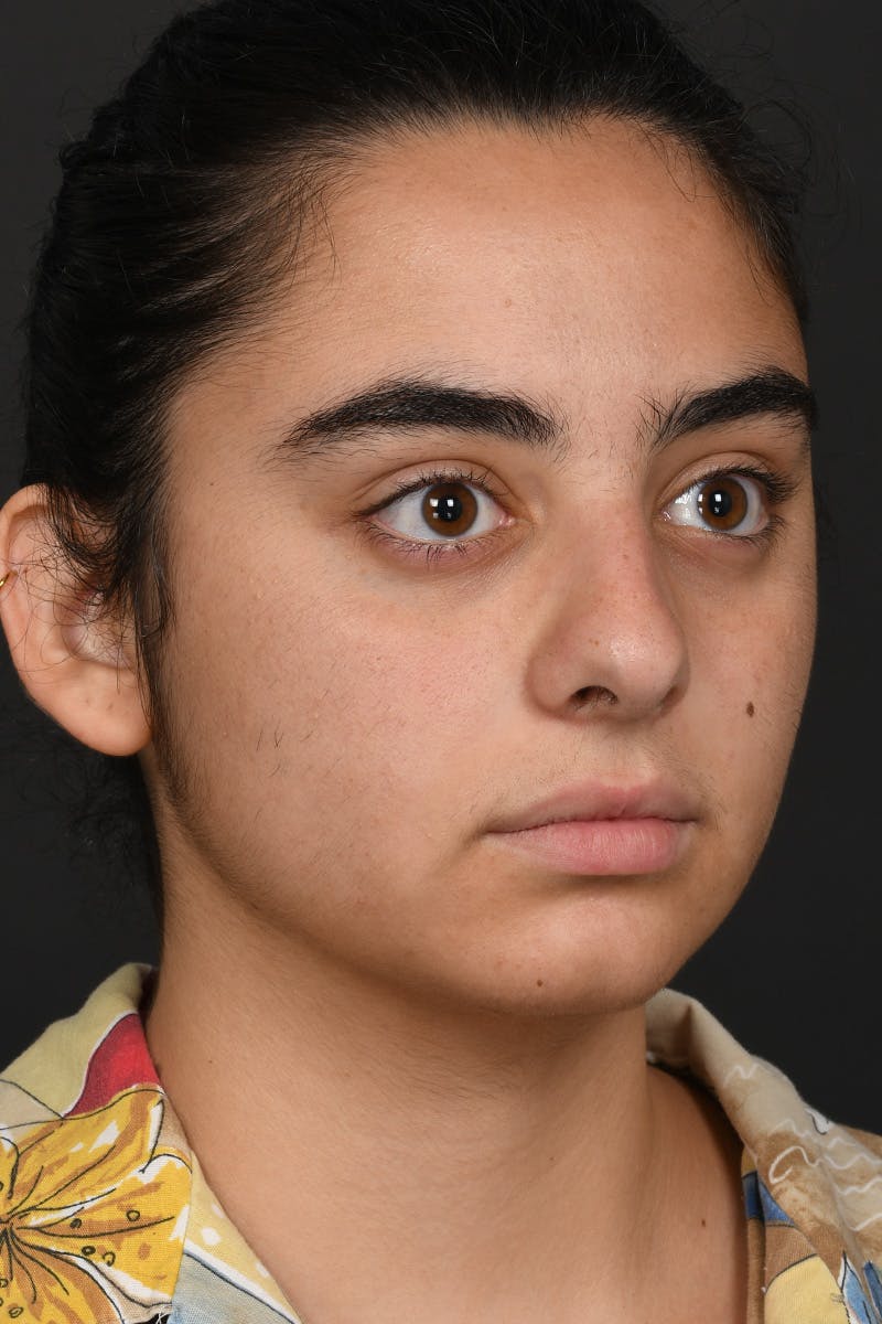 Rhinoplasty Before & After Gallery - Patient 393416 - Image 5