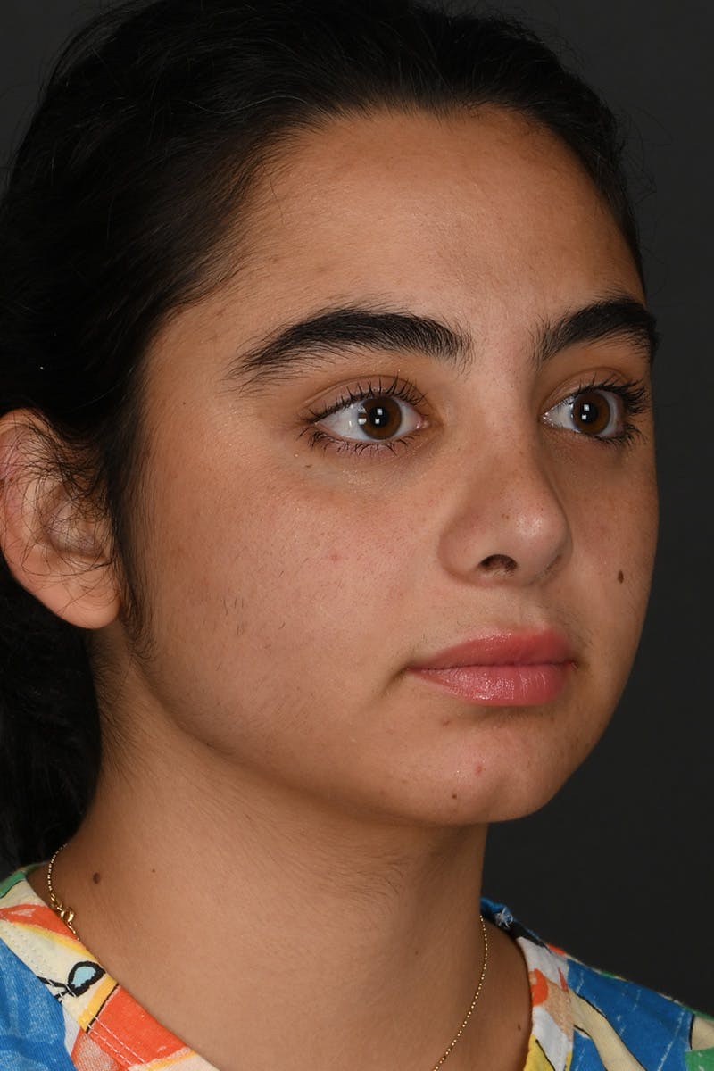 Rhinoplasty Before & After Gallery - Patient 393416 - Image 6