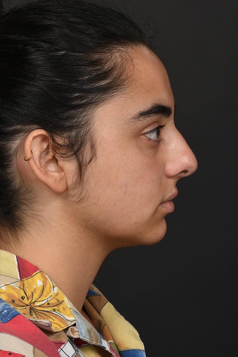 Rhinoplasty Before & After Gallery - Patient 393416 - Image 7