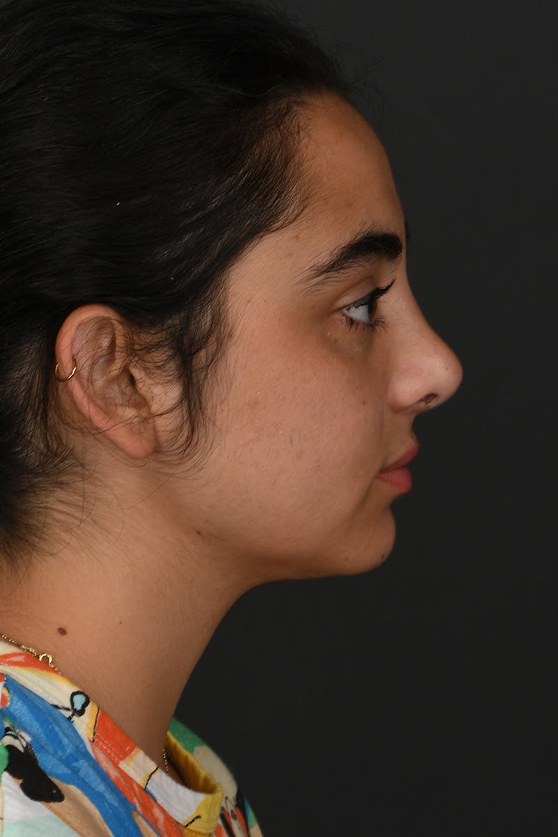 Rhinoplasty Before & After Gallery - Patient 393416 - Image 8