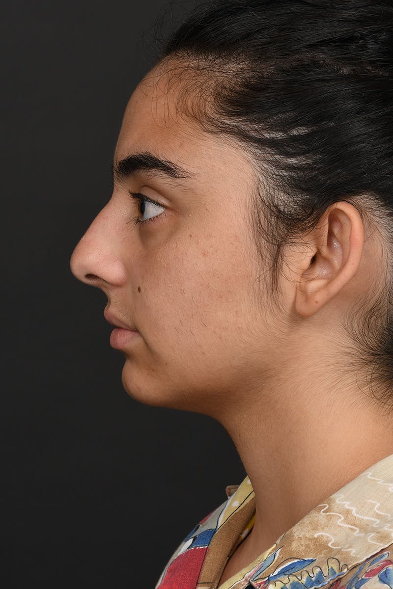 Rhinoplasty Before & After Gallery - Patient 393416 - Image 1