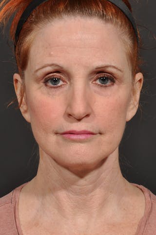 Facelift Before & After Gallery - Patient 134624 - Image 2