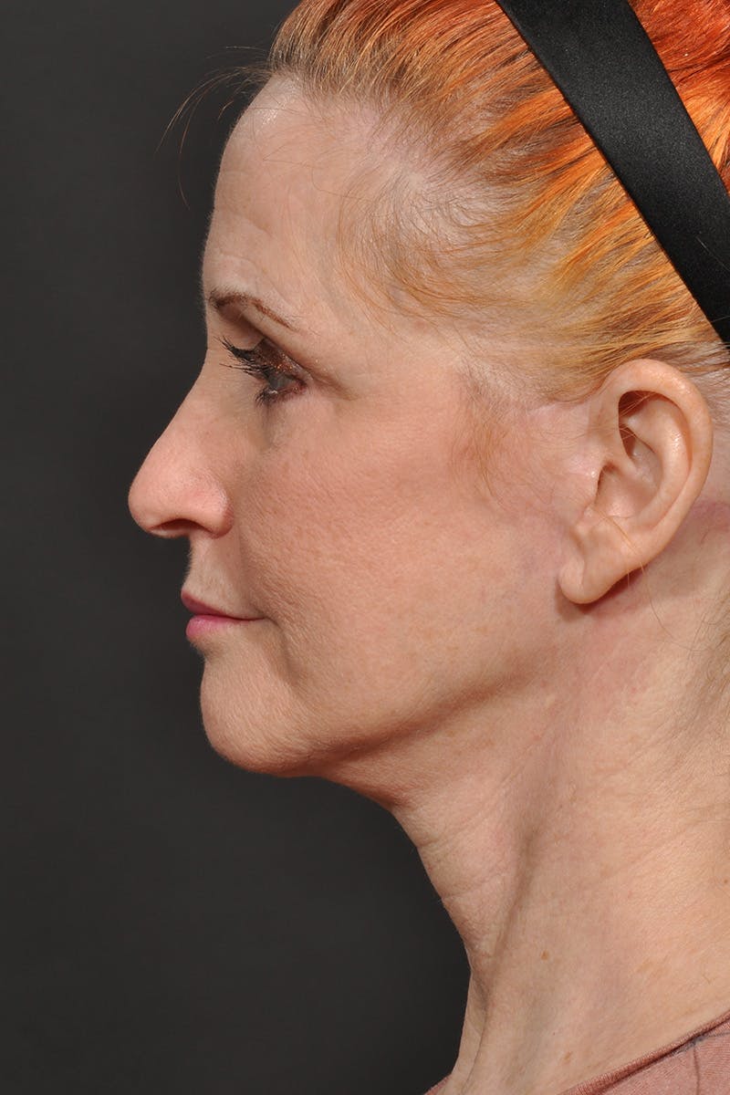 Facelift Before & After Gallery - Patient 134624 - Image 6