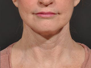 Neck Lift Before & After Gallery - Patient 297837 - Image 2