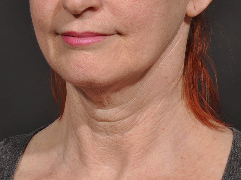 Neck Lift Before & After Gallery - Patient 297837 - Image 3