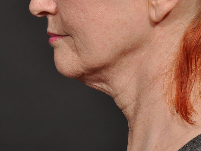 Neck Lift Before & After Gallery - Patient 297837 - Image 5