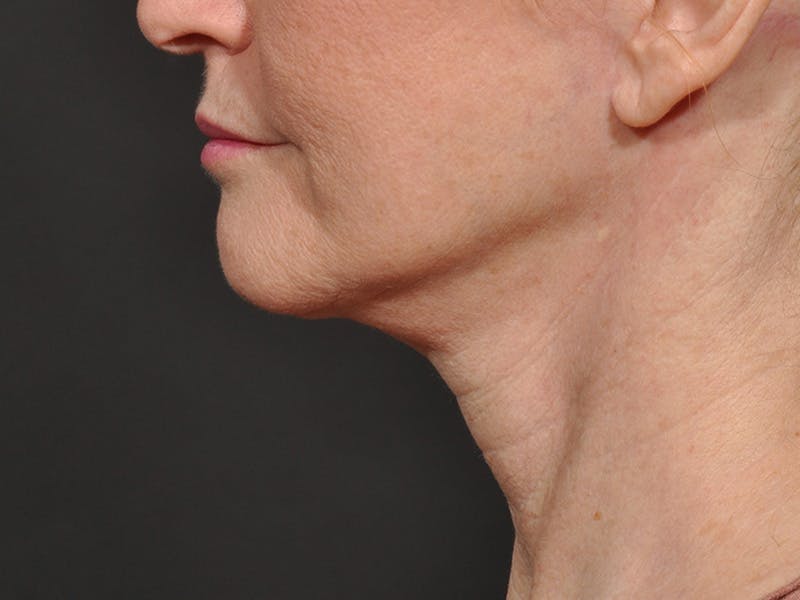 Neck Lift Before & After Gallery - Patient 297837 - Image 6