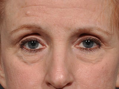 Blepharoplasty Before & After Gallery - Patient 566278 - Image 1