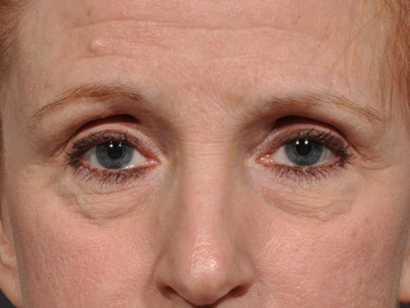 Blepharoplasty Before & After Gallery - Patient 566278 - Image 1