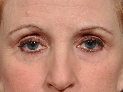 Blepharoplasty Before & After Gallery - Patient 566278 - Image 2