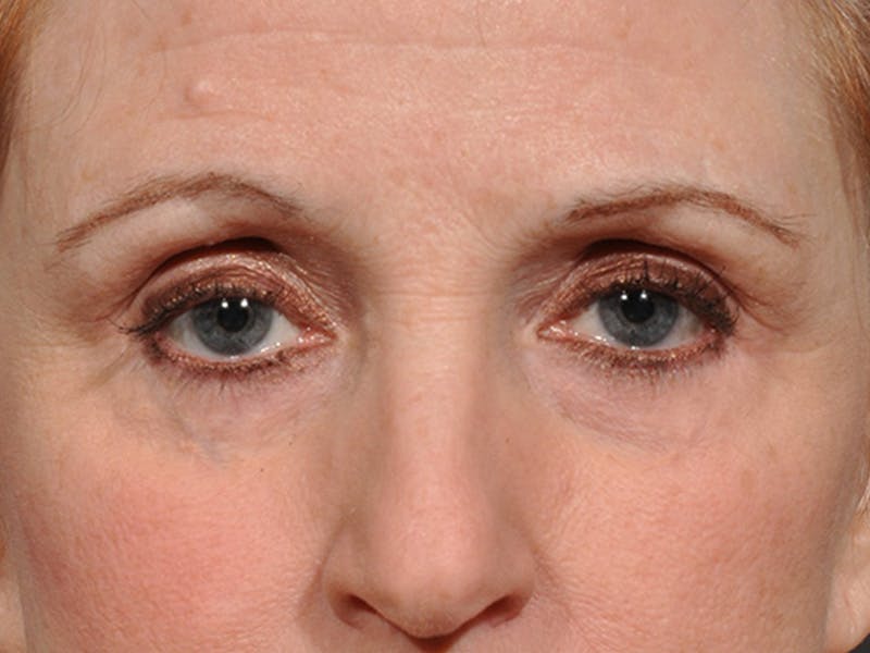 Blepharoplasty Before & After Gallery - Patient 566278 - Image 2