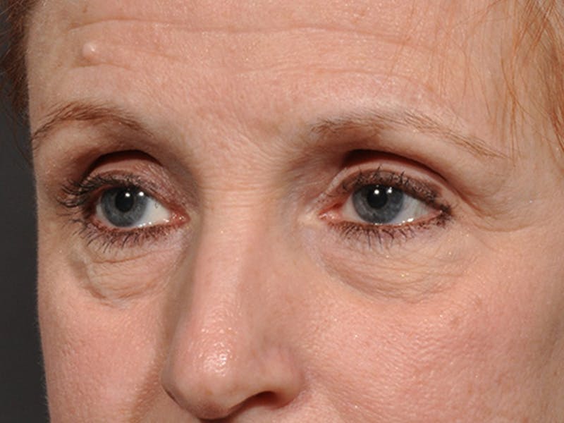 Blepharoplasty Before & After Gallery - Patient 566278 - Image 3