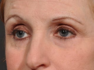 Blepharoplasty Before & After Gallery - Patient 566278 - Image 4