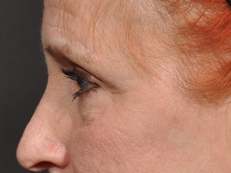 Blepharoplasty Before & After Gallery - Patient 566278 - Image 5