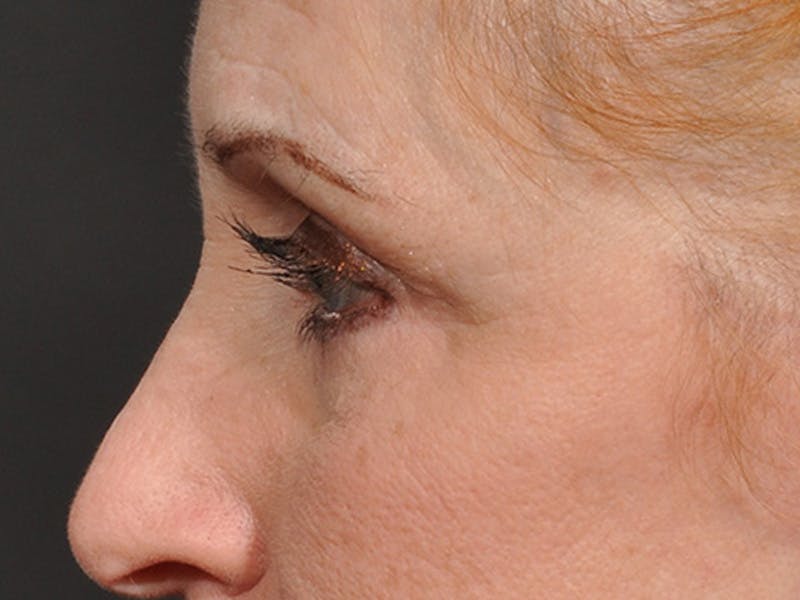 Blepharoplasty Before & After Gallery - Patient 566278 - Image 6