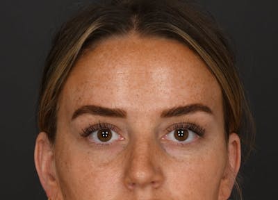 Brow Lift Before & After Gallery - Patient 377660 - Image 2