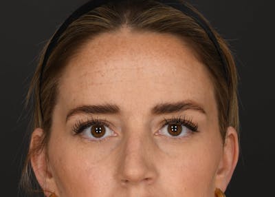 Brow Lift Before & After Gallery - Patient 377660 - Image 1
