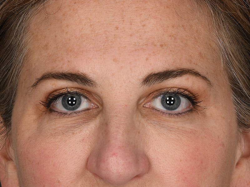 Blepharoplasty Before & After Gallery - Patient 104404 - Image 2
