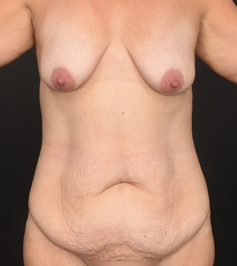 Mommy Makeover Before & After Gallery - Patient 105037 - Image 1