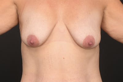 Breast Lift Before & After Gallery - Patient 392228 - Image 1
