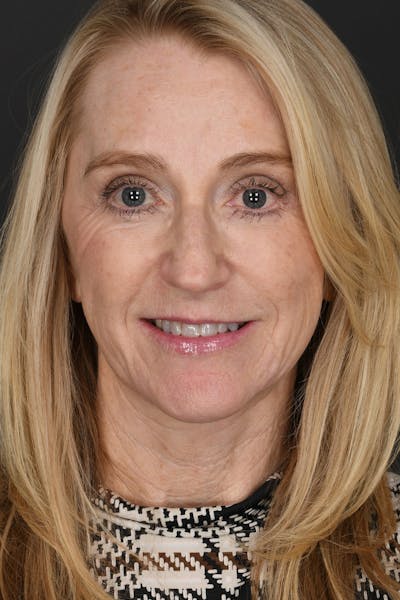 Facelift Before & After Gallery - Patient 323987 - Image 2