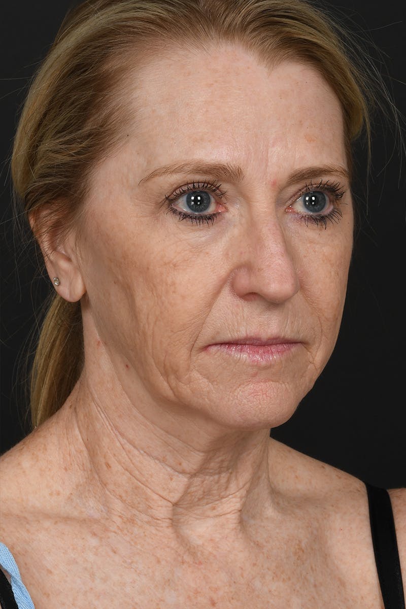 Facelift Before & After Gallery - Patient 323987 - Image 3