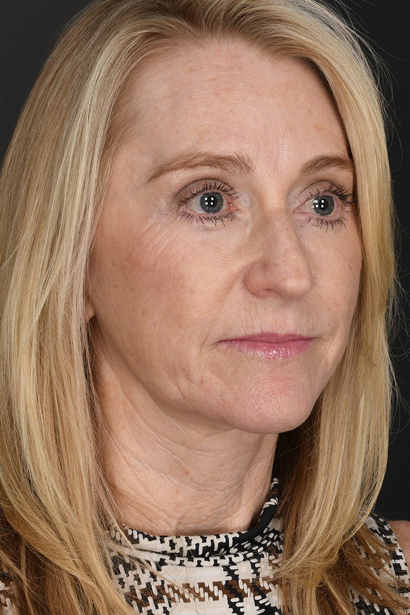 Facelift Before & After Gallery - Patient 323987 - Image 4